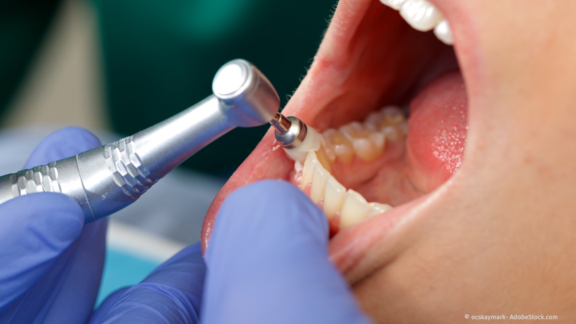 Gründliche und schonende Entfernung aller Zahnbeläge bei der Parodontitisbehandlung