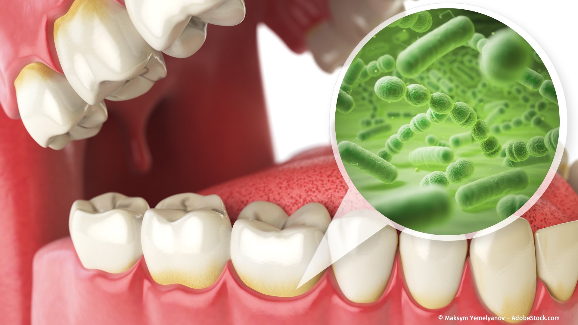 Bakterien im Zahnbelag sind die Hauptverursacher einer Parodontitis