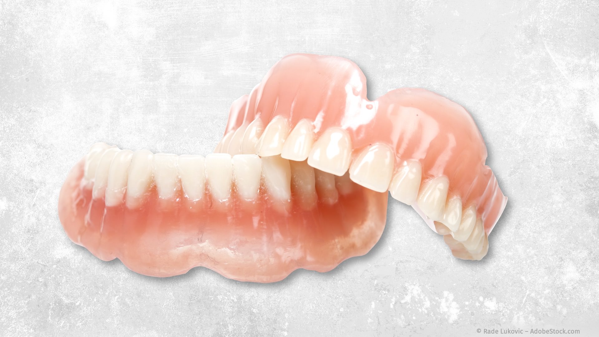 Totalprothesen, wenn alle Zähne fehlen