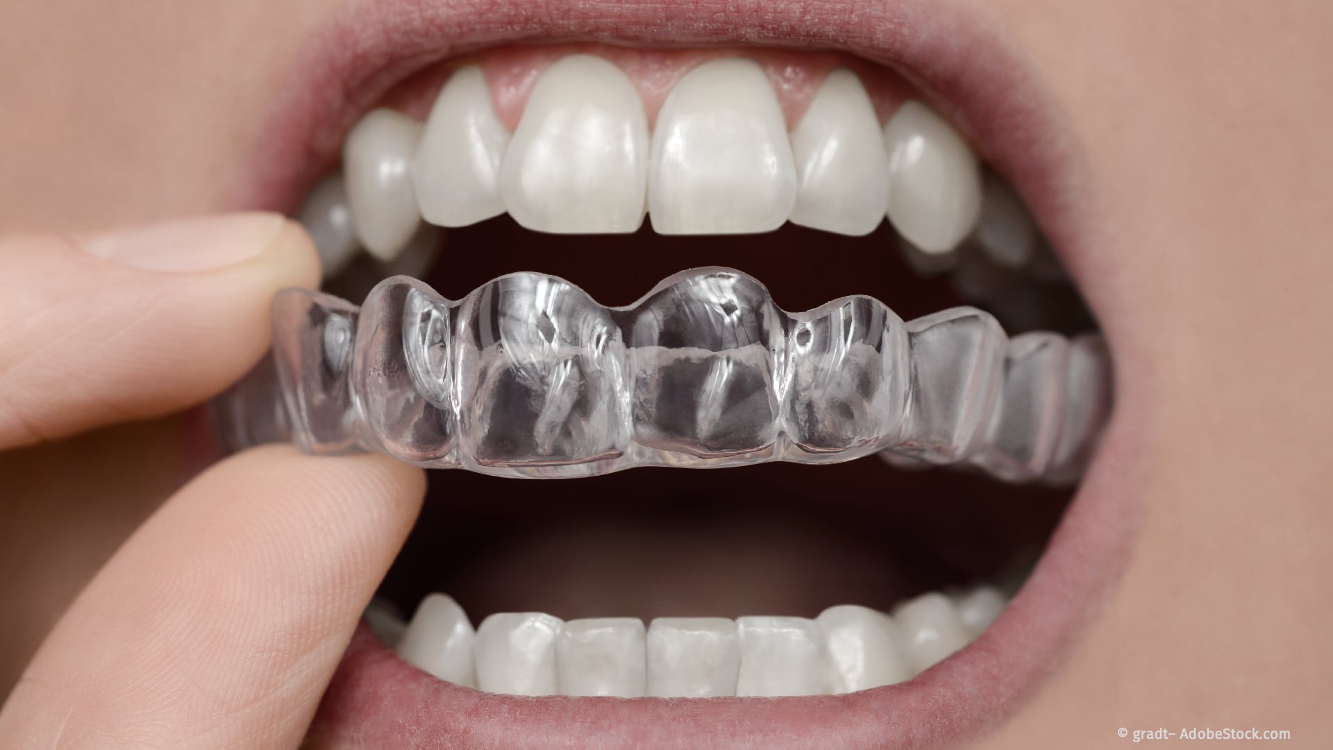 Aufbissschiene (Knirscherschiene) gegen nächtliches Zähneknirschen und Zähnepressen